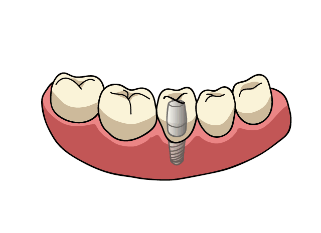 しらゆり歯科医院の入れ歯とインプラントの違い