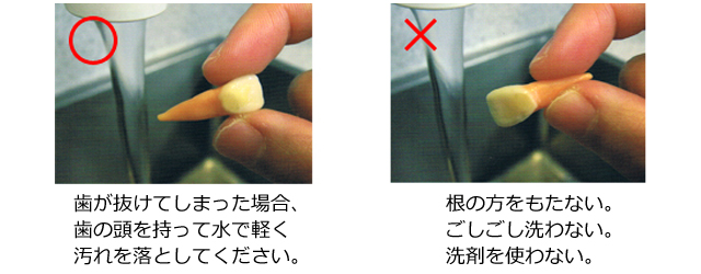 しらゆり歯科医院の歯科口腔外科・歯が抜けたときの対処法