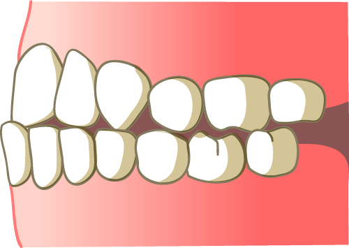 しらゆり歯科 反対咬合になる原因